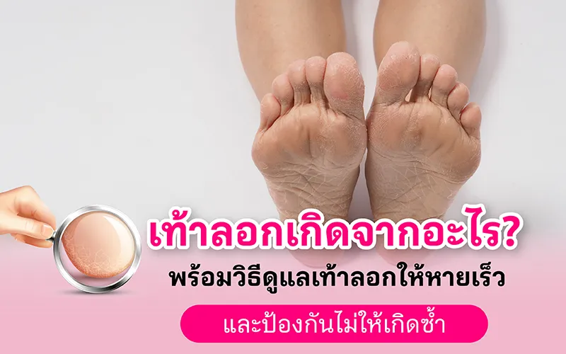 เท้าลอกเกิดจากอะไร พร้อมวิธีดูแลเท้าลอกให้หายเร็ว และป้องกันไม่ให้เกิดซ้ำ 02